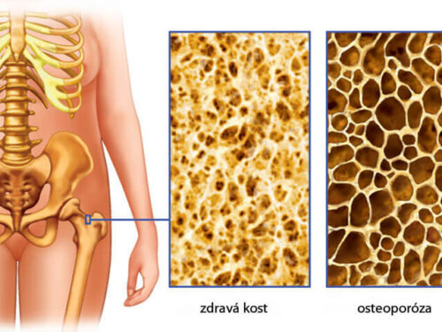 Osteoporóza – epidémia tretieho tisícročia