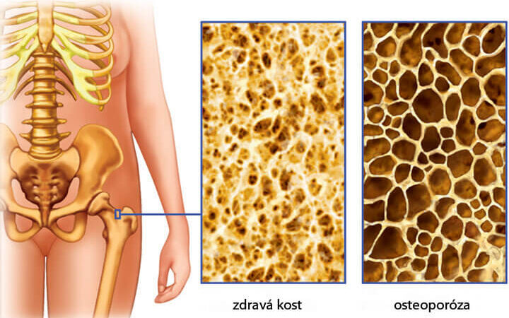 Osteoporóza – epidémia tretieho tisícročia