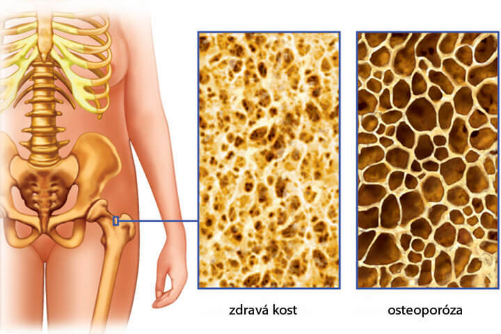 Osteoporóza – epidémia tretieho tisícročia